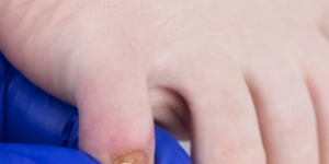 micose unhas por que aparecem evitar tratar