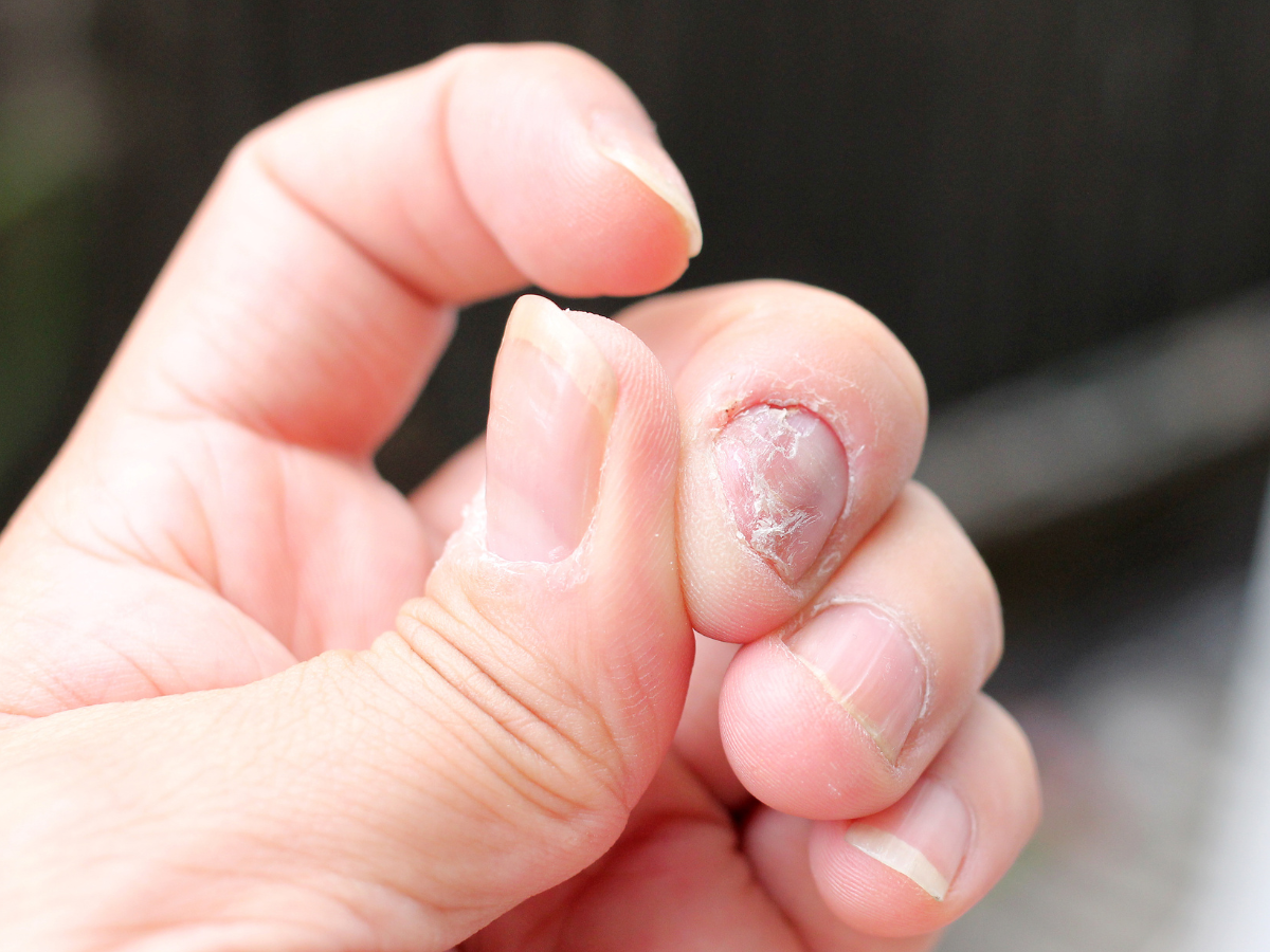 Unhas encravadas na mão
